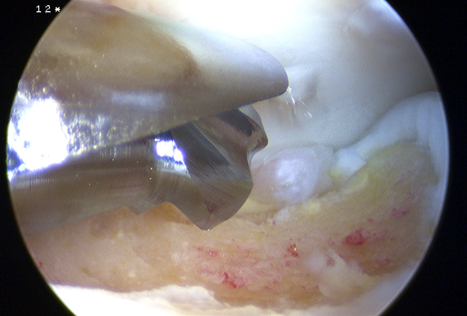 Ankle Scope OCD Abrasion